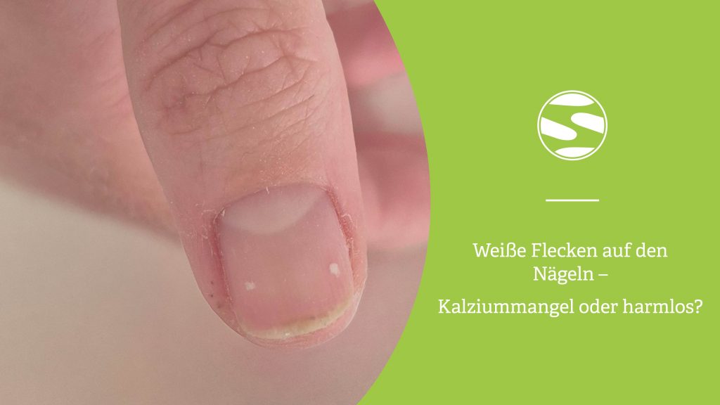 Nahaufnahme eines Daumens mit zwei kleinen weißen Flecken auf dem Naturnagel – Ursachen, Pflege und Tipps von spitzengefühl
