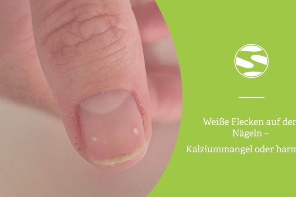 Nahaufnahme eines Daumens mit zwei kleinen weißen Flecken auf dem Naturnagel – Ursachen, Pflege und Tipps von spitzengefühl