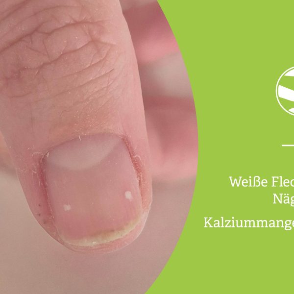 Nahaufnahme eines Daumens mit zwei kleinen weißen Flecken auf dem Naturnagel – Ursachen, Pflege und Tipps von spitzengefühl