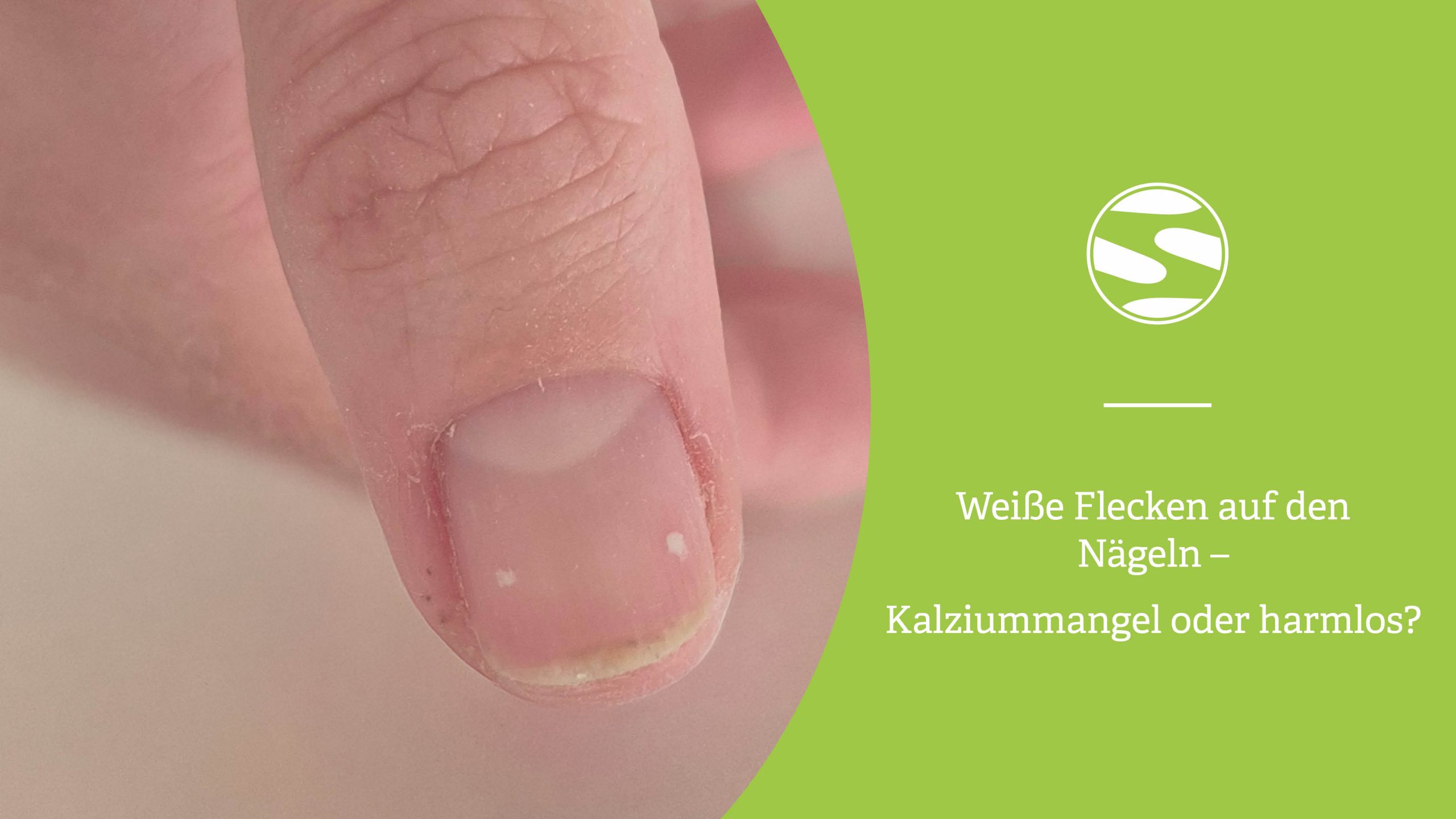 Nahaufnahme eines Daumens mit zwei kleinen weißen Flecken auf dem Naturnagel – Ursachen, Pflege und Tipps von spitzengefühl